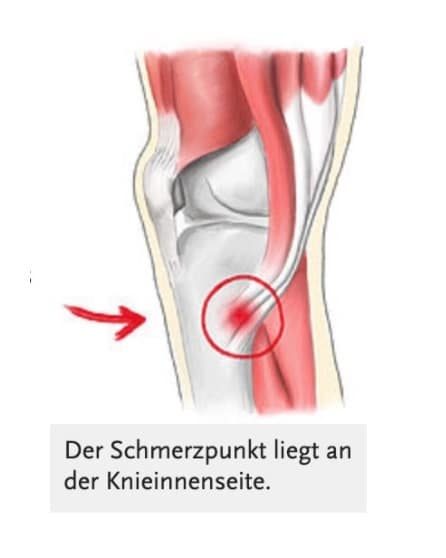 Sehnenstruktur an der Innenseite des Unterschenkels unterhalb des Kniegelenks, an dem drei Muskeln ansetzen