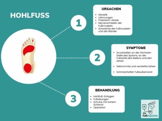 Eine Infografik zum Thema Hohlfuß mit Ursachen, Symptomen und Behandlungsmöglichkeiten
